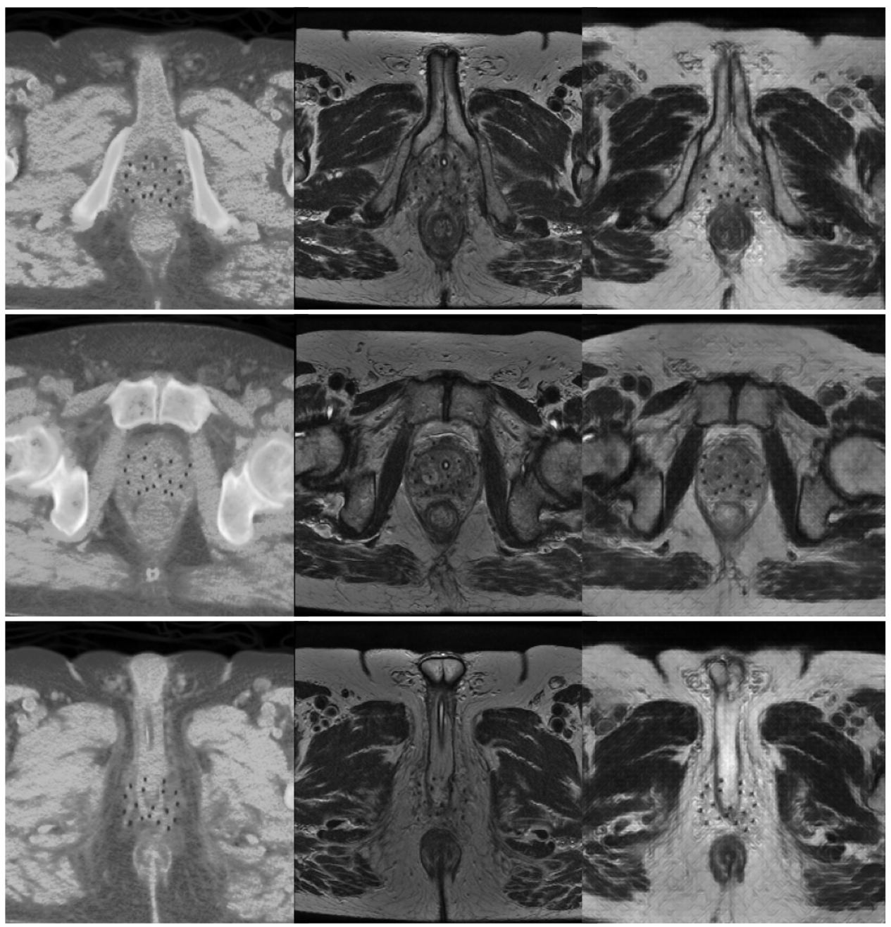 CT-to-MRI Synthesis for High-dose-rate Brachytherapy Treatment Planning