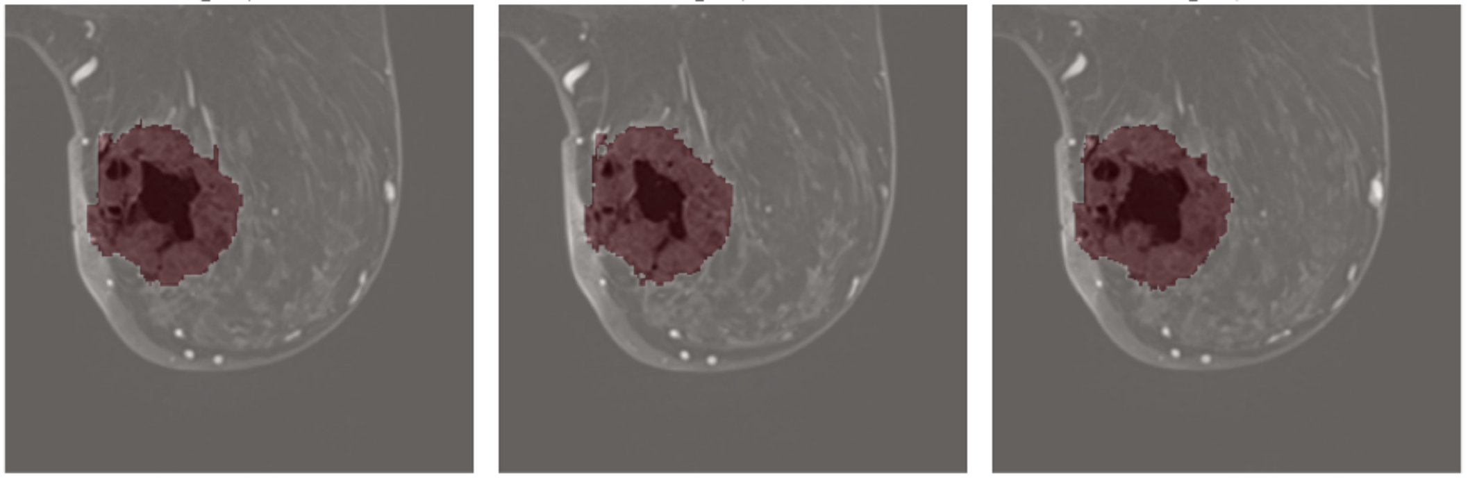 Slice-Aware Attention for Quality Control of Breast MRI Segmentations